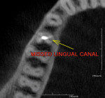 Figure 9  An axial slice showing an untreated lingual canal.