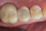 Figure 2  A 4-year recall image of a tooth restored with Surpass, a flowable composite (Titan, Apex), and a microhybrid (Vit-l-escence®, Ultradent).
