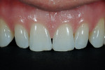 Figure 5  Notice the incisal wear along with the horizontal “craze” line on the incisal third of tooth No. 10.