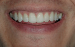 Figure 6  Custom composite prototypes that were hand-sculpted in the mouth and allowed the patient to “test drive” their new smile.