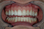 Figure 9  Right side try-in of Durathin veneers to compare ceramic work with the prototypes on the left side.