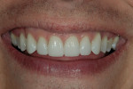Figure 11  The final restorations (Durathin veneers on teeth Nos. 5 through 12) accomplished the patient’s goals without any tooth reduction.