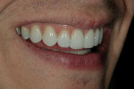 Figure 12  The final restorations (Durathin veneers on teeth Nos. 5 through 12) accomplished the patient’s goals without any tooth reduction.