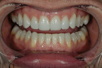 Figure 14  The final restorations (Durathin veneers on teeth Nos. 5 through 12) accomplished the patient’s goals without any tooth reduction.