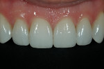 Figure 15  The final restorations (Durathin veneers on teeth Nos. 5 through 12) accomplished the patient’s goals without any tooth reduction.