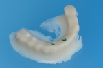 Fig 5. A screw-retained duplicate of the hybrid prosthesis is made of bisacrylic.