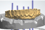 Fig 7. Approved PMMA provisional is cut back to allow space for esthetic porcelain, as seen in this graphic representation of CAD/CAM file.