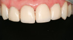 Figure 2  Preoperative view of the deteriorating four incisor veneers.