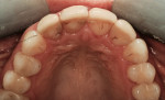 Figure 3  Preoperative incisal view of the four veneers.