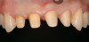 Figure 4  Occlusal view of the healed bony ridge, taken at the time of implant placement.