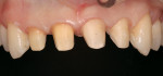 Figure 5  Preparations of the four incisors. Full coverage on teeth Nos. 7 and 8; veneer preparations on tooth Nos. 9 and 10.