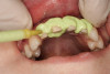 Figure 6  Buccal view of the final restoration on the implant inserted in site No. 27. Note the excellent maintenance of the soft-tissue contours.