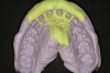 Figure 7  Occlusal view 18 months after the final restoration was inserted. Note the amount of preservation of hard and soft tissues.