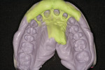 Figure 8  Final impression of teeth Nos. 7 through 10.