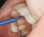 Figure 20  Removal of excess resin material during the bonding process of teeth Nos. 9 and 10.