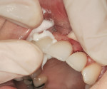 Figure 22  Insertion of full-coverage crowns on teeth Nos. 7 and 8.
