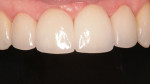 Figure 24  Close-up postoperative view of four incisor veneers.