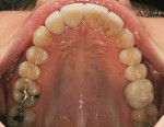 Figure 25  Postoperative incisal view of the new restorations.