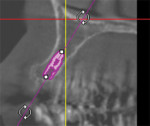 Fig 2. CBCT scan was taken to help plan placement of a 3.6 mm x 9 mm Astra Tech Implant System EV (Dentsply Sirona) implant and short healing abutment.