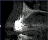 Figure 12  Right buccal view showing posterior occlusion established, canine guidance and proper space appropriation around peg lateral tooth No. 7, and intruded worn incisors.