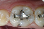 Figure 1  The patient, a 36-year-old man, presented with the need and desire to replace a leaking amalgam restoration on tooth No. 30.