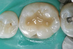 Figure 9  The one-step, 4-mm increment had great adaptability to the preparation walls, leaving the final 1.5 mm of the preparation to be restored with Venus Diamond Universal Composite.