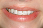 Figure 12  Full smile at 1-year postimplant.