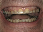 Figure 1  A 40-year-old man presented with the desire to improve his smile and restore his worn enamel.