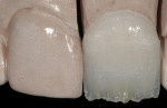 Figure 12  The trial unit was pressed with high-translucency ceramic, then cut back for layering with layering porcelain.