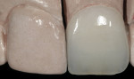 Figure 13  The trial unit was pressed with high-translucency ceramic, then cut back for layering with layering porcelain.