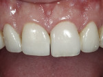 Figure 14  After evaluating color, translucency, anatomy, and surface texture, the patient approved the trial unit.