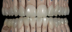Figure 15  View of the completed case on the models so that the fit and interproximal contacts could be verified.