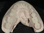 Figure 16  View of the completed case on the models so that the fit and interproximal contacts could be verified.