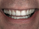 Figure 22  Postoperative view of the patient’s restored smile.