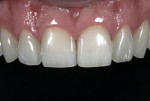 Figure 23  Close-up retracted view of the high-translucency restorations used to provide the patient with natural-looking, esthetic, and high-strength restorations.