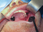 Fig 1. Left-sided maxillary tumor resection, zygomatic and oncology implant placement, impression, and registration procedures.