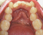 Figure 11  The collapsed mandibular arch form shows crowded and twisted teeth along with the collapse of the buccal corridors.