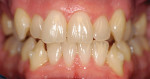 Figure 14  The correction after just 8 months of Invisalign therapy.