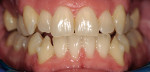 Figure 17  This image was taken after 18 months of Invisalign therapy. The arches were expanding and the teeth were beginning to find good positions in the arch form.