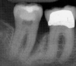 Figure 2  Pretreatment radiograph of tooth No. 31 showing an 11-mm defect on the mesial-lingual aspect.