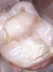 Figure 5  RMGI applied over exposed dentin and calcium hydroxide followed by restoration.