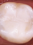 Figure 6  RMGI applied over exposed dentin and calcium hydroxide followed by restoration.