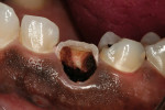Figure 1  The patient presented with a severely decayed maxillary right canine with irreversible pulpitis.