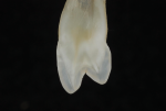 Fig 1a. As seen in cross-sections of teeth, maintaining a true cusp-to-fossa relationship is not always the norm.