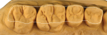 Fig 6. The angulation of the mandibular buccal cusps and the maxillary buccal occlusal incline planes are what help to keep the food on the occlusal table.
