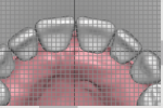 Fig 11. In the digital workflow, anterior and posterior teeth can be analyzed utilizing a reference grid for measuring facial surface of teeth to incisive papillae. The smile line, midline, incisal edge position, and buccal corridor are also analyzed with a 1-mm grid overlay.