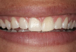 Figure 1  Preoperative full smile demonstrating excessive gingival display, short uneven length, and negative space in the buccal corridor.