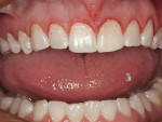 Figure 2  Postoperative photograph 1 month after completing the gingivectomy.