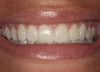 Figure 5  A patient presented needing both centrals extracted. Note the excellent papillary height and free gingival margin location.