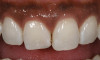 Figure 13  Twelve months after placement, soft tissue migrated apically as bone between the implants continued to resorb.